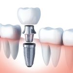 Diferencia entre una prótesis y un implante dental